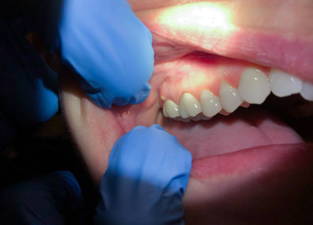 Best Emergency Tooth Extraction in Woodlawn, VA